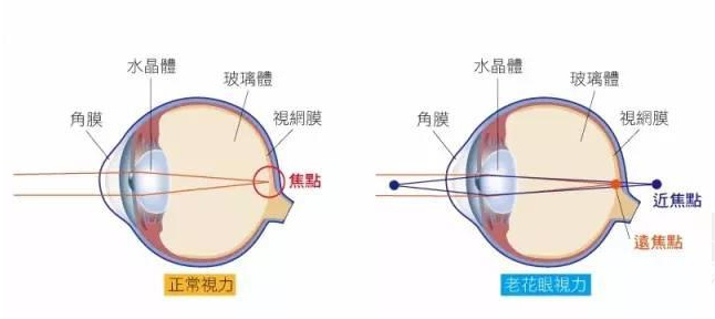 白內障和老花眼區(qū)別，老花眼發(fā)病率正呈現(xiàn)年輕化趨勢