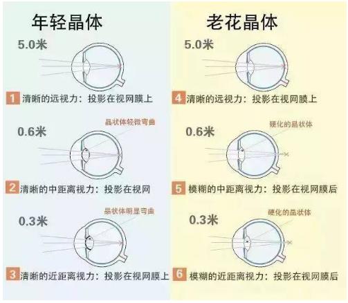 近視就不會(huì)老花了嗎？